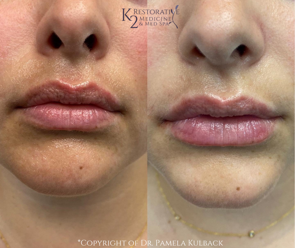 Before and after Lip Enhancement via PDO Threads by Dr. Pamela Kulback