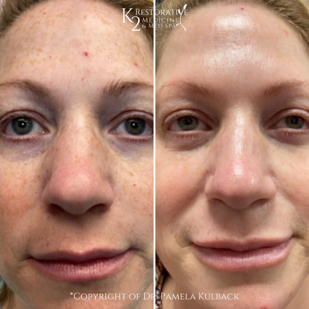 Before and after only 2 IPL (Photo Facials)
