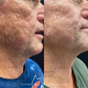 Patient Before and after Virtue RF Microneedling and CoolPeel™