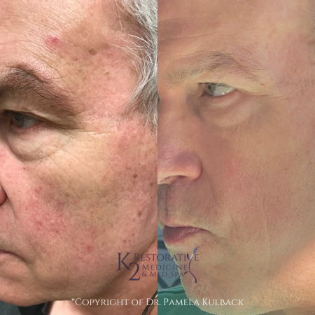 Before and after IPL and One CoolPeel™ Laser Treatments to reduce redness, even out skin tone, minimize broken blood vessels, and tighten skin.