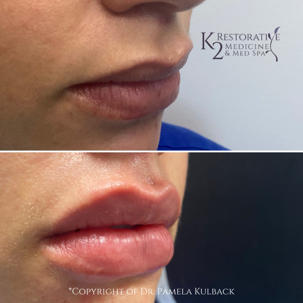Right Side View Before and After Restylane Kysse Lip Filler offered at K2 Restorative Medicine