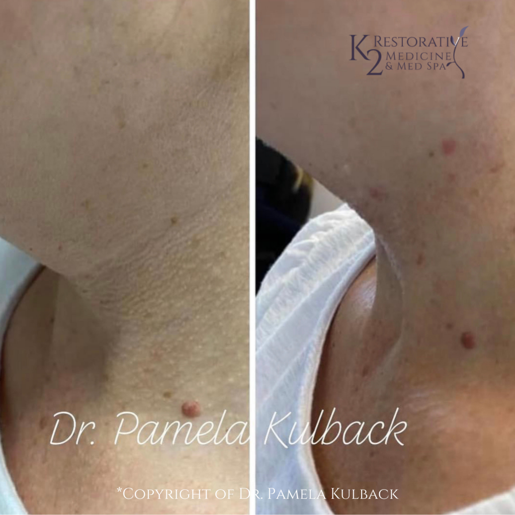Before and after PDO Thread-Lift of the neck by Dr. Pamela Kulback