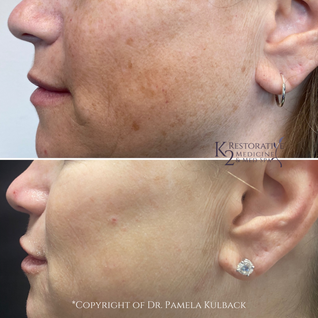 Before and after 6-months - 2 IPL Treatments, PDO Thread-Lift of the Mid-Face, 2 syringes of filler, and Kysse lip filler. Performed by Dr. Pamela Kulback