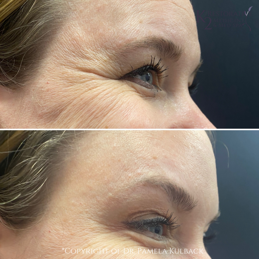 Dysport Results for Wrinkles offered at K2 Restorative Medicine