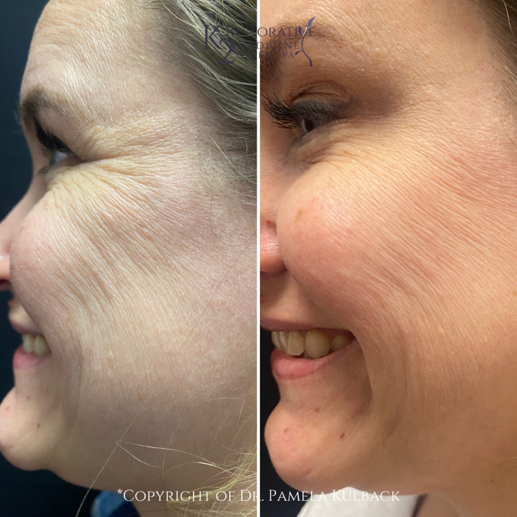 Dysport Results for Wrinkles offered at K2 Restorative Medicine