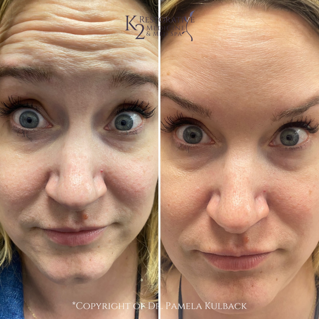 Dysport Results for Wrinkles offered at K2 Restorative Medicine