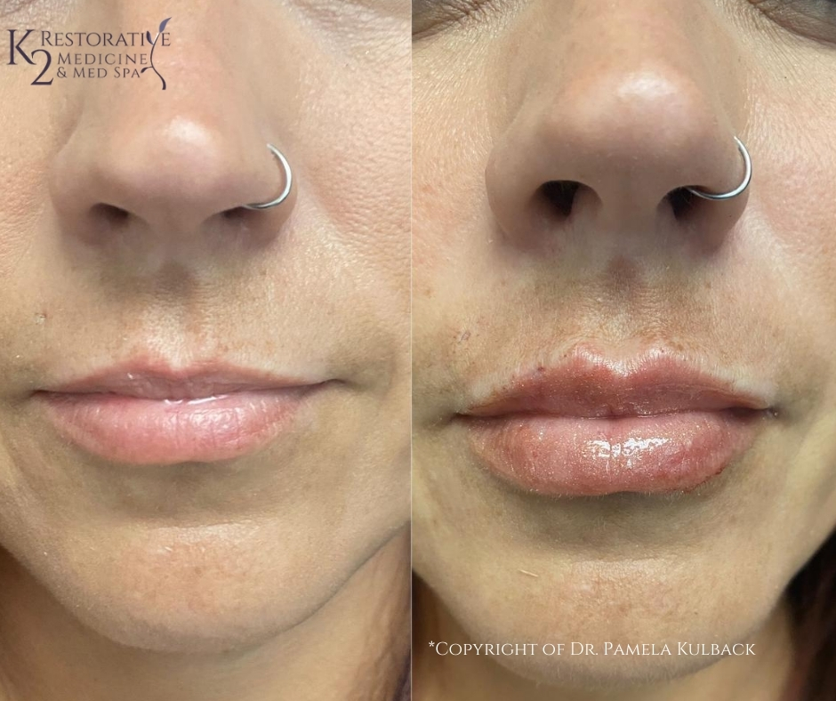 Before and immediately after one syringe of Restylane Kysse for added volume and softness