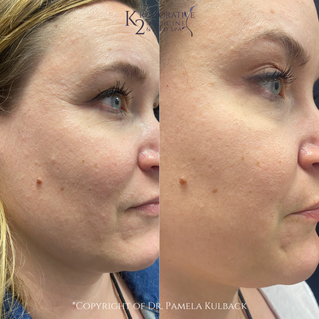 SkinPen Microneedling Facial Special Offered at K2 Restorative Medicine