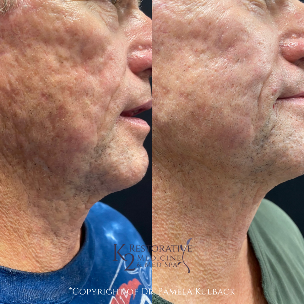 Progress Picture - Before and after 2 Morpheus 8 Microneedling RF Treatments and one CooLPeel™ Patient will undergo additional treatments. Stay tuned.