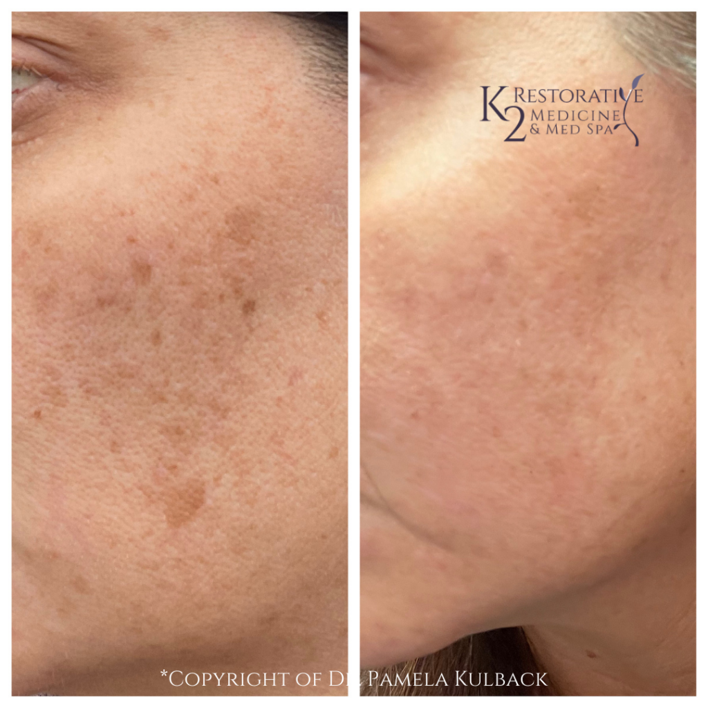 1 HydraFacial with brightening serum Before and After - K2 Restorative Medicine