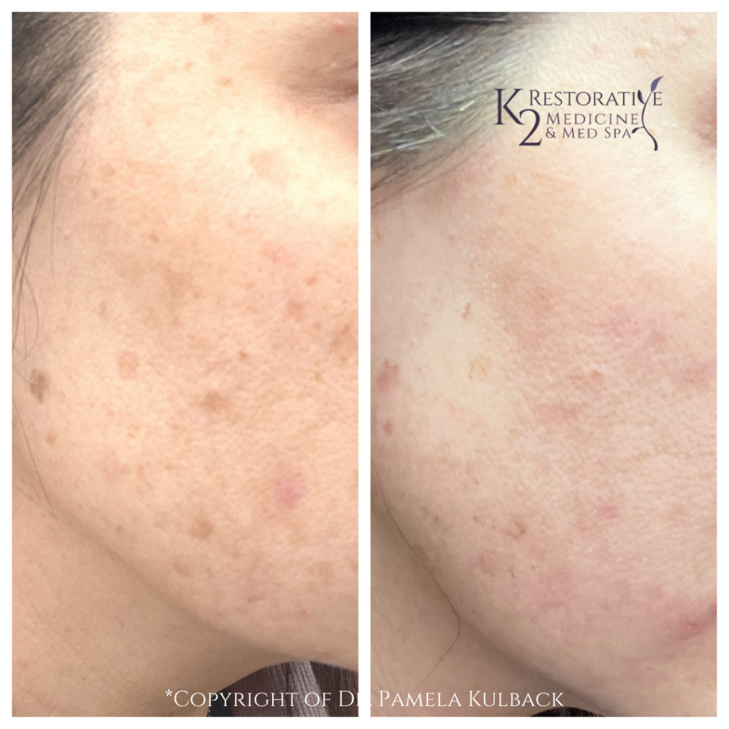 1 HydraFacial with brightening serum Before and After - K2 Restorative Medicine