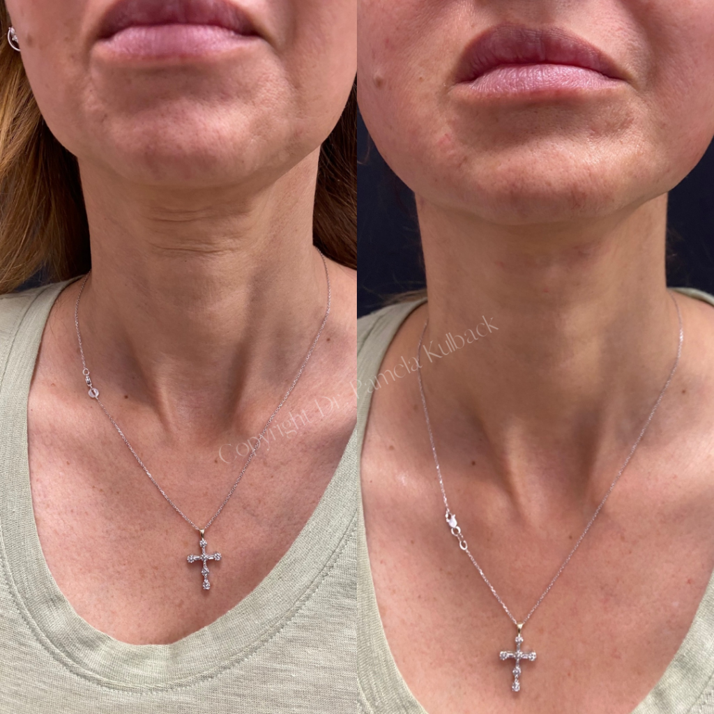 Before and immediately after PDO Thread-Lift to enhance and lift jawline and neck.