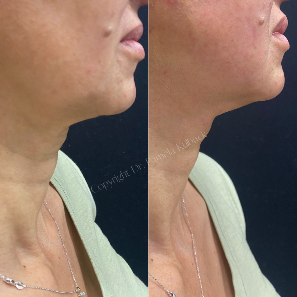 Before and immediately after PDO Thread-Lift to enhance and lift jawline and neck.