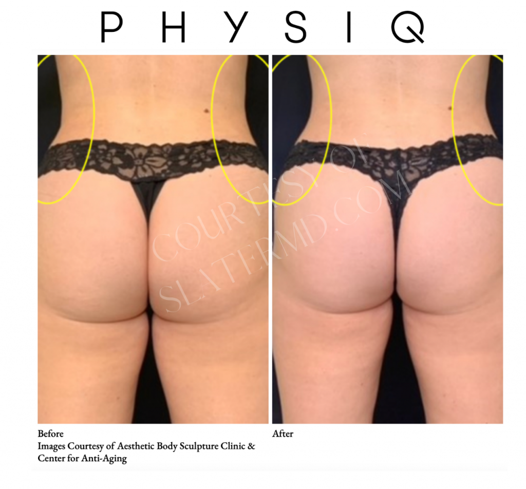 PHYSIQ BEFORE AND AFTER