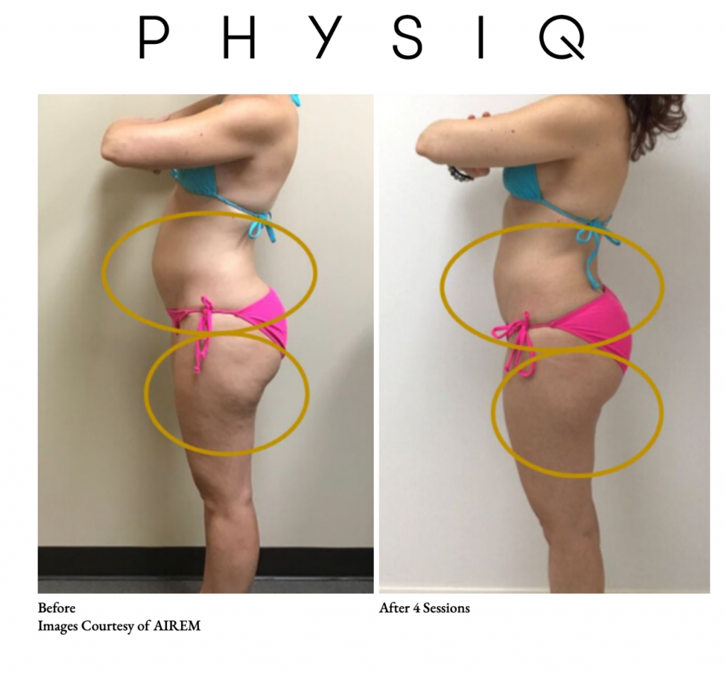 PHYSIQ Body Contouring  Target Fat & Stimulate Muscle Tone