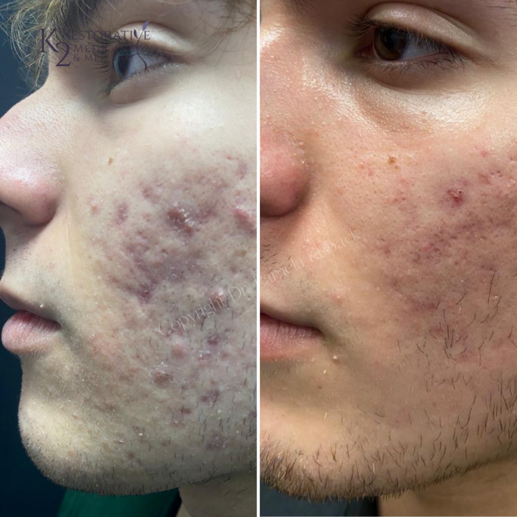 Before & After 3 Fractora Treatments with PRP and custom acne skin care.