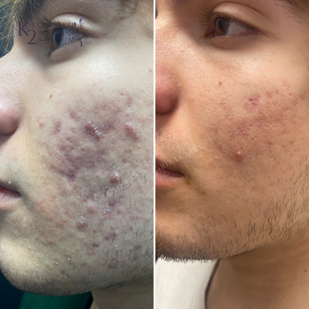 Before & After 4 Fractora Treatments with PRP and custom acne skin care. (2)