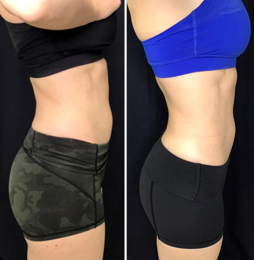 ab stimulator before and after