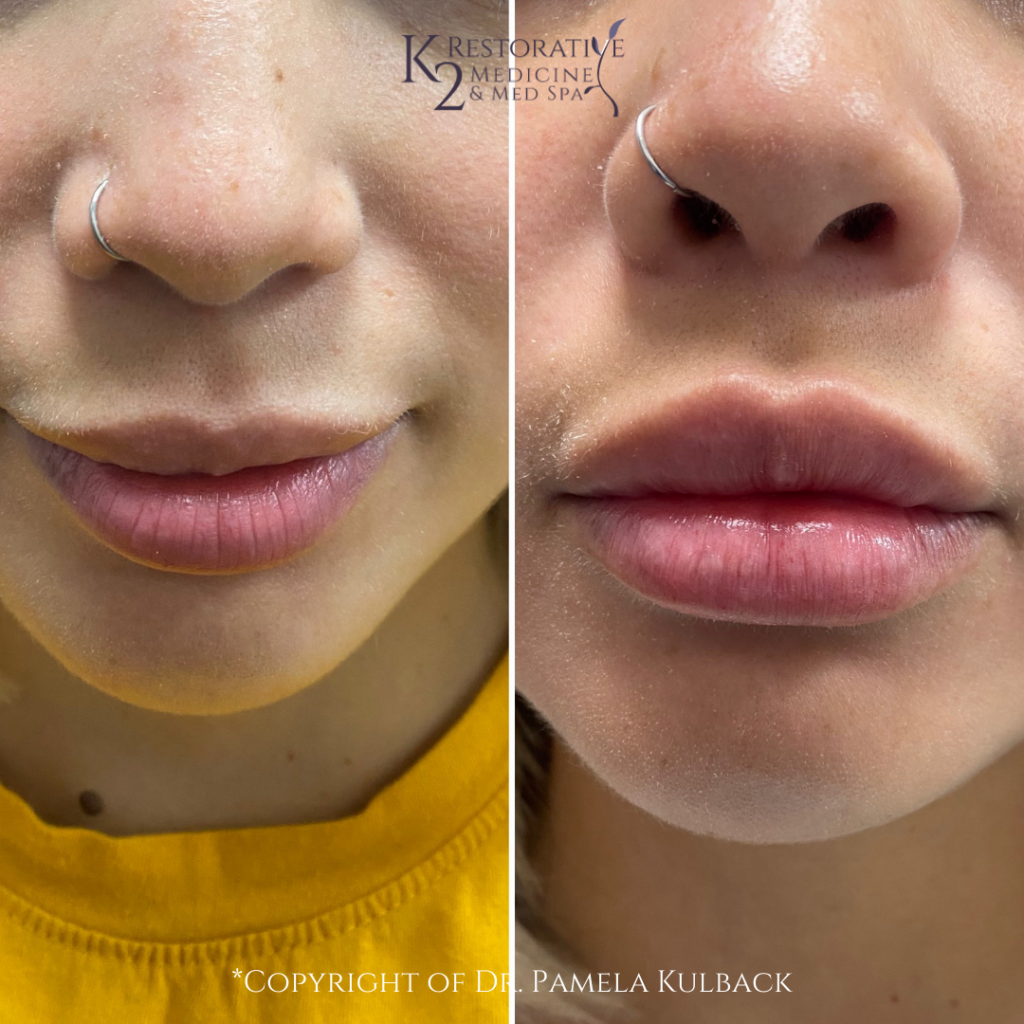 Before and after Restylane KYSSE Lip Filler at K2 Restorative Medicine