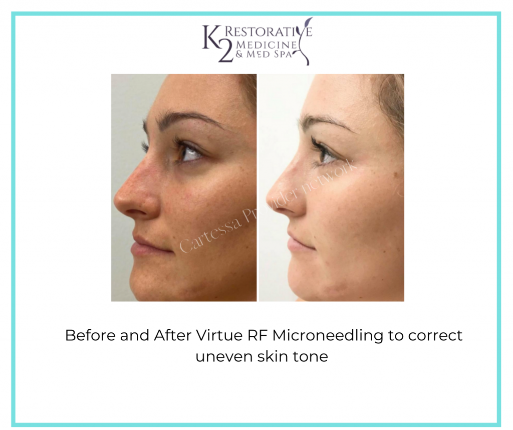 Before and After Virtue RF Microneedling with Dr. Pamela Kulback in Alabama 