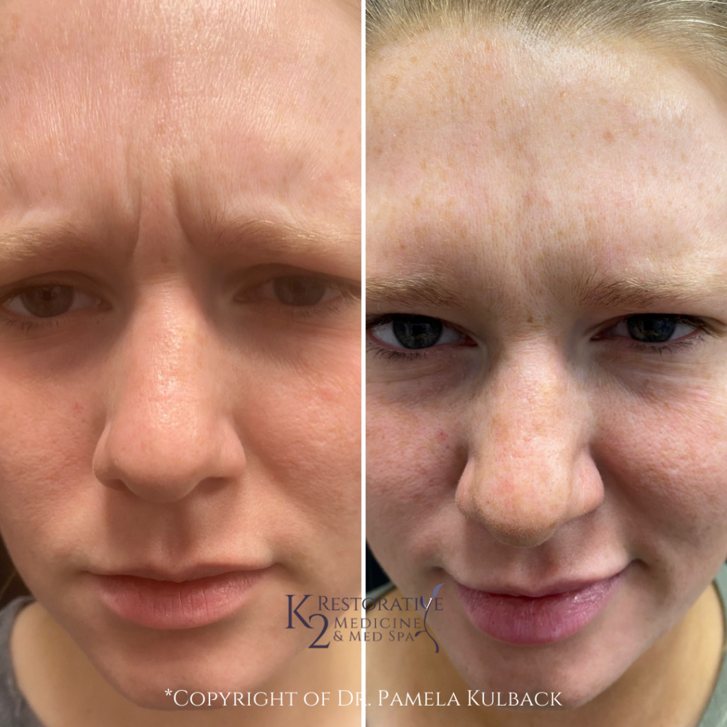 Before and after 2 weeks of Receiving Botox for forehead lines and frown lines by Dr. Pamela Kulback