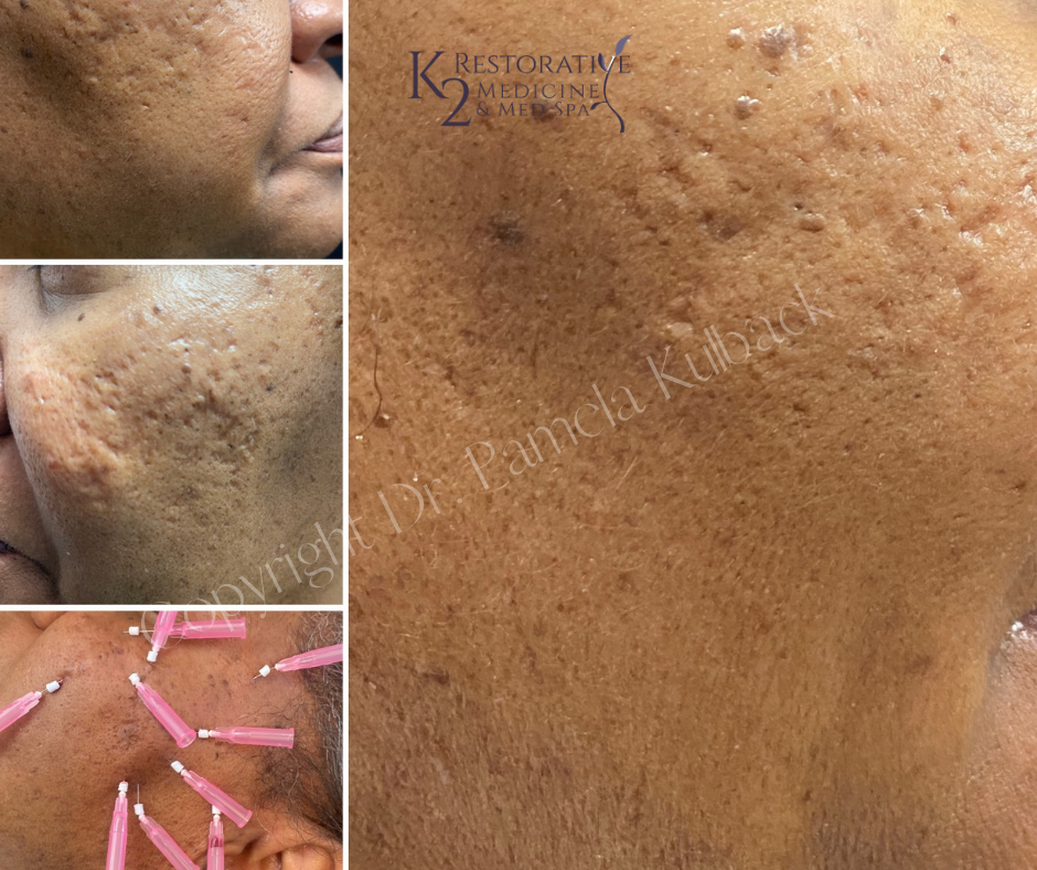 Before and after 3 Acne Scarring Treatments with PDO Threads and PRP (Platelet Rich Plasma) performed by Dr. Pamela Kulback