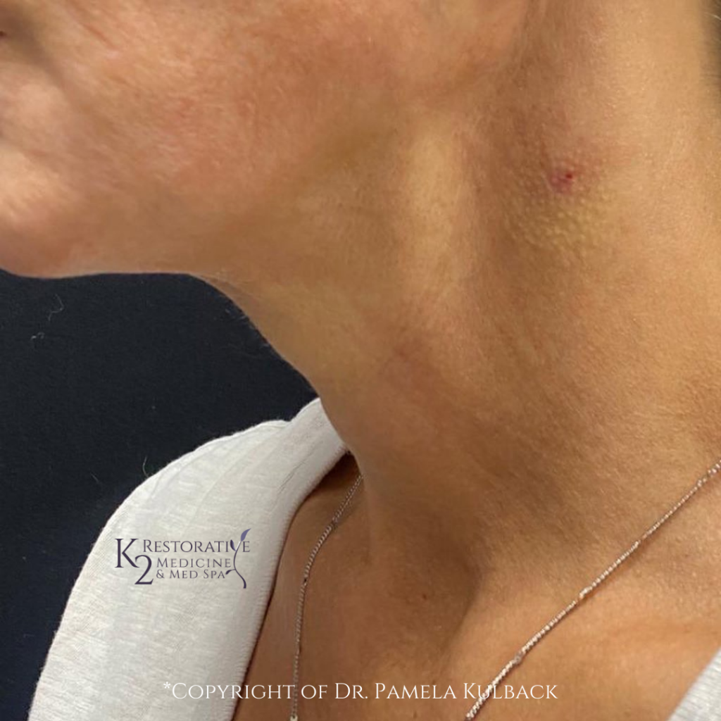 Before and After PDO Thread-Lift of the neck by Dr. Pamela Kulback - K2 Restorative Medicine