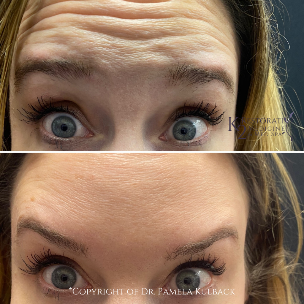 Our Patient Before and 2 Weeks After Dysport for Forehead Line- at K2 Restorative Medicine