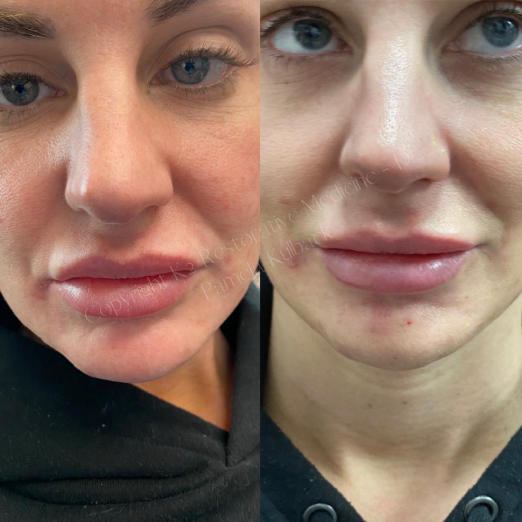 Before & after PDO threads for Chin contouring and Restylane filler for deep crease below lower lip- New Skin Medical Before & After