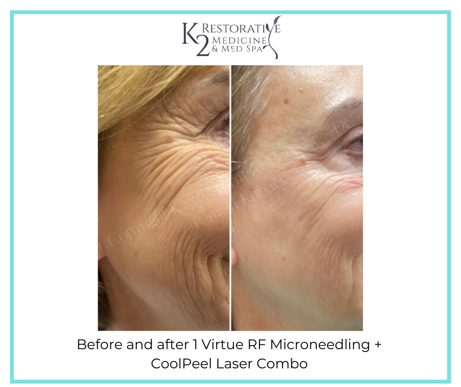 Before and after 1 Virtue RF Microneedling + CoolPeel Laser Combo by Dr. Pamela Kulback