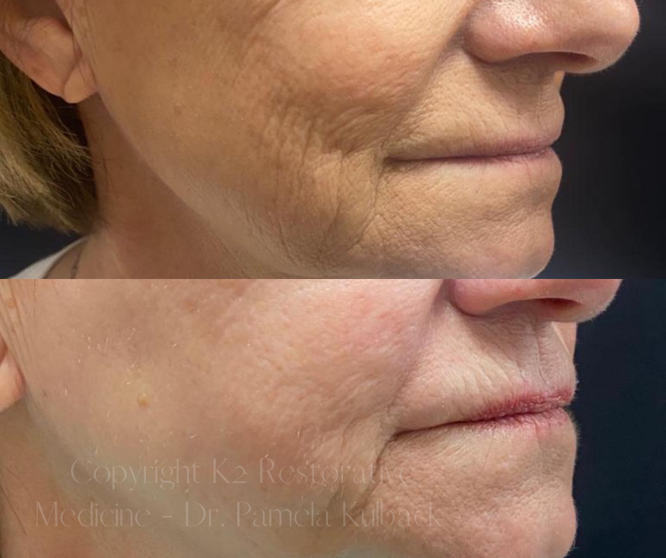 Before and after 1 Virtue RF Microneedling + CoolPeel Laser Combo by Dr. Pamela Kulback