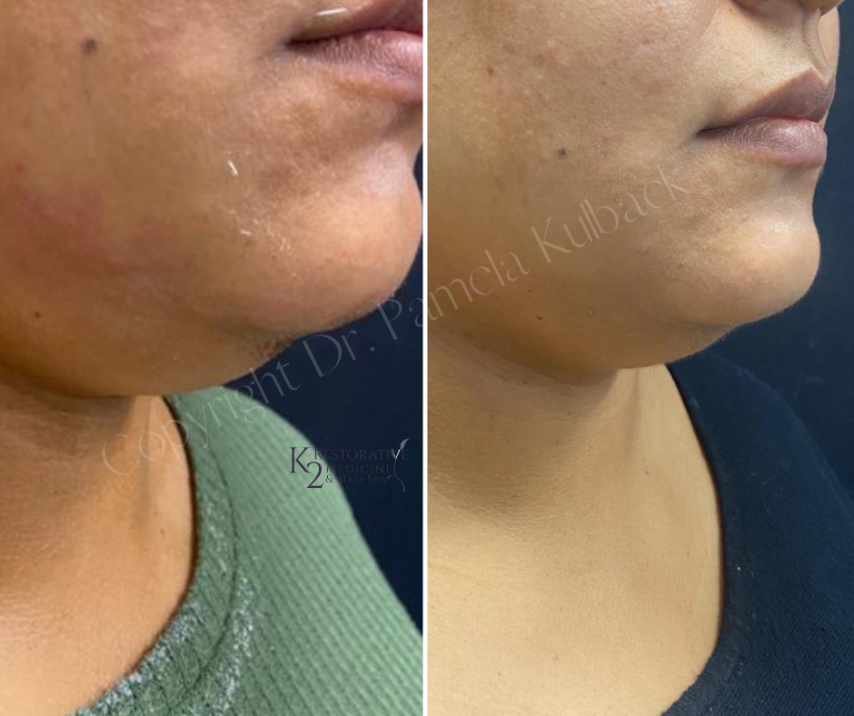 Before and after 1 month of 1st Kybella treatment for Double Chin (3 treatments needed for best results)   with Dr. Pamela Kulback in Trussville, Alabama