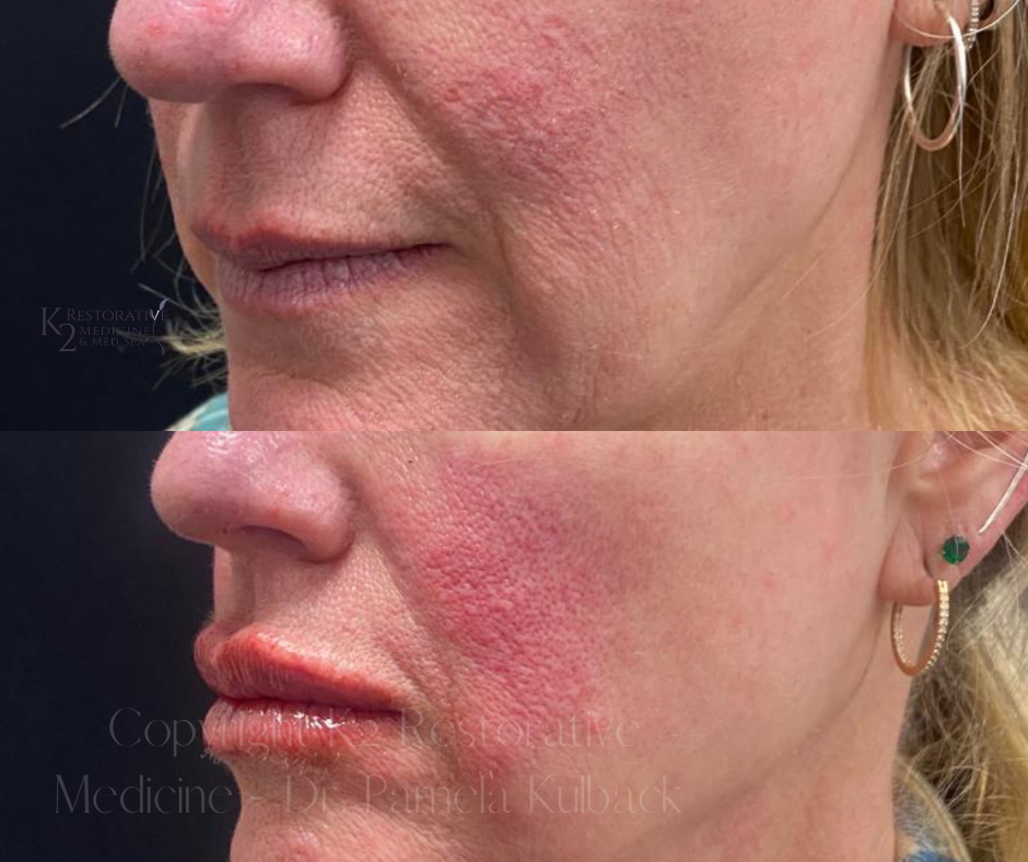 Right Side view - Before and immediately after Restylane KYSSE by Dr. Pamela Kulback