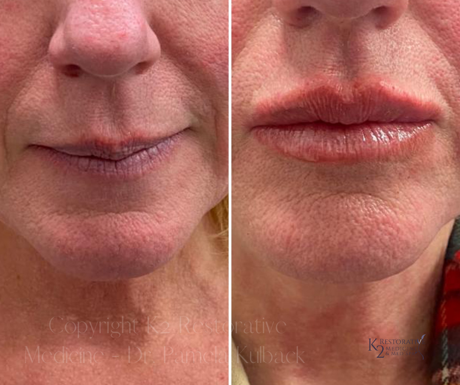 Front View -Before and immediately after Restylane KYSSE by Dr. Pamela Kulback