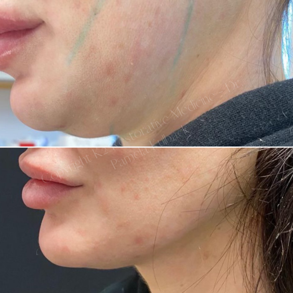 Before and after PDO Threadlift for the lower face and chin