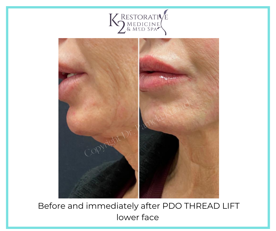 Before and immediately after PDO THREAD LIFT lower face by Dr. Pamela Kulback