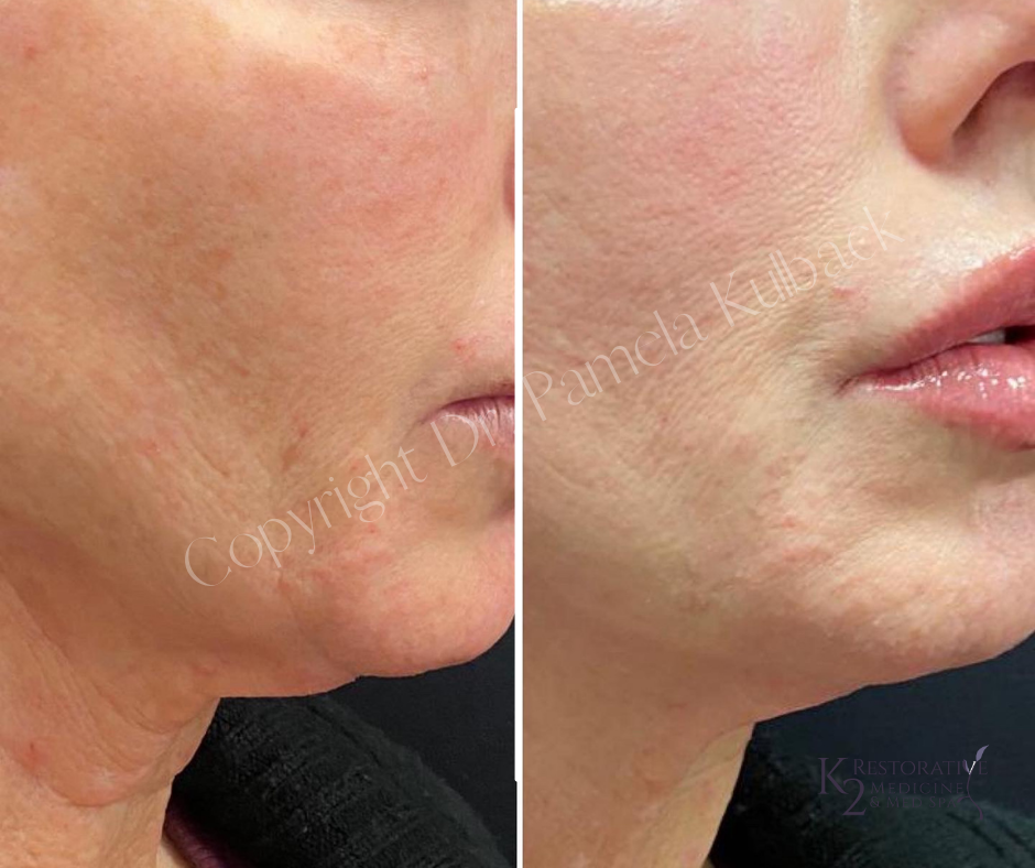 Before and immediately after PDO THREAD LIFT lower face by Dr. Pamela Kulback (7)