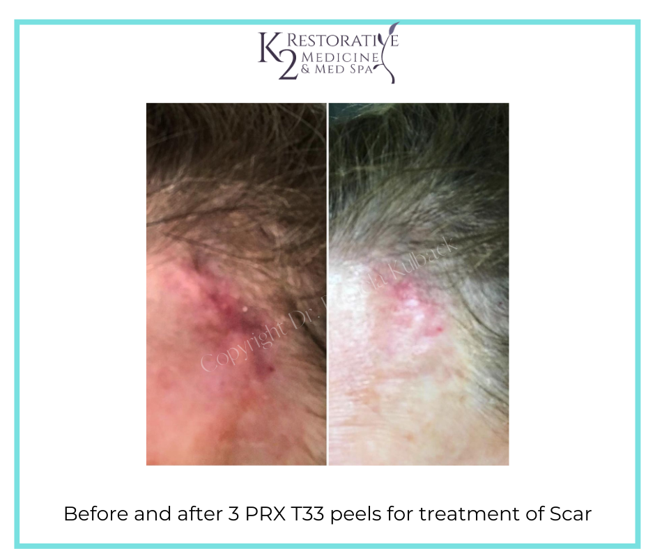 Before & after 3 PRX T33 peels for treatment of Scar- K2 Restorative Medicine
