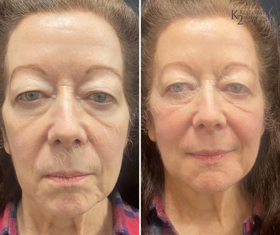 Before and immediately after first round (2vials) of Sculptra for skin laxity of mid-face and lower face