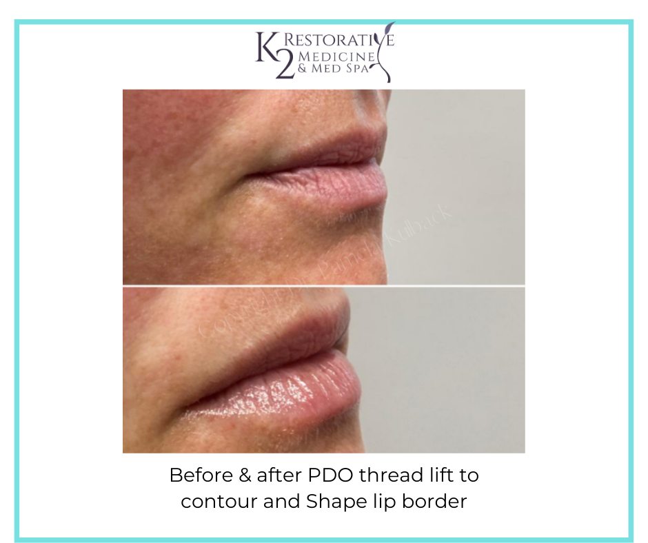 Before & after PDO thread lift to contour and Shape lip border - by Dr. Pamela Kulback - K2 Restorative Medicine (3)