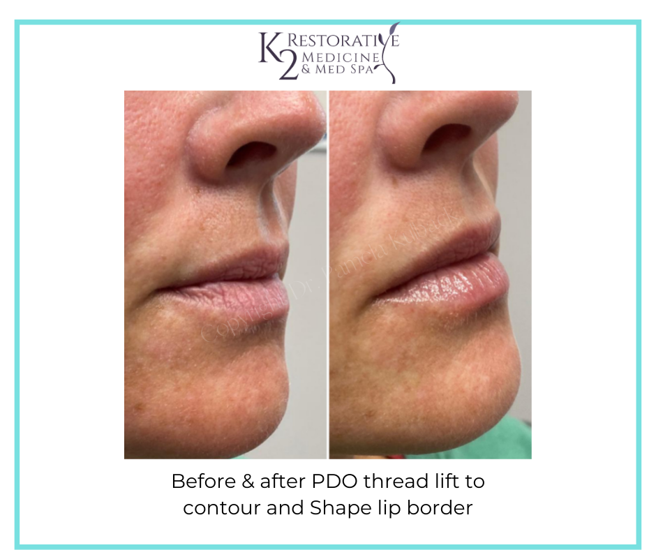 Before & after PDO thread lift to contour and Shape lip border - by Dr. Pamela Kulback - K2 Restorative Medicine (3)