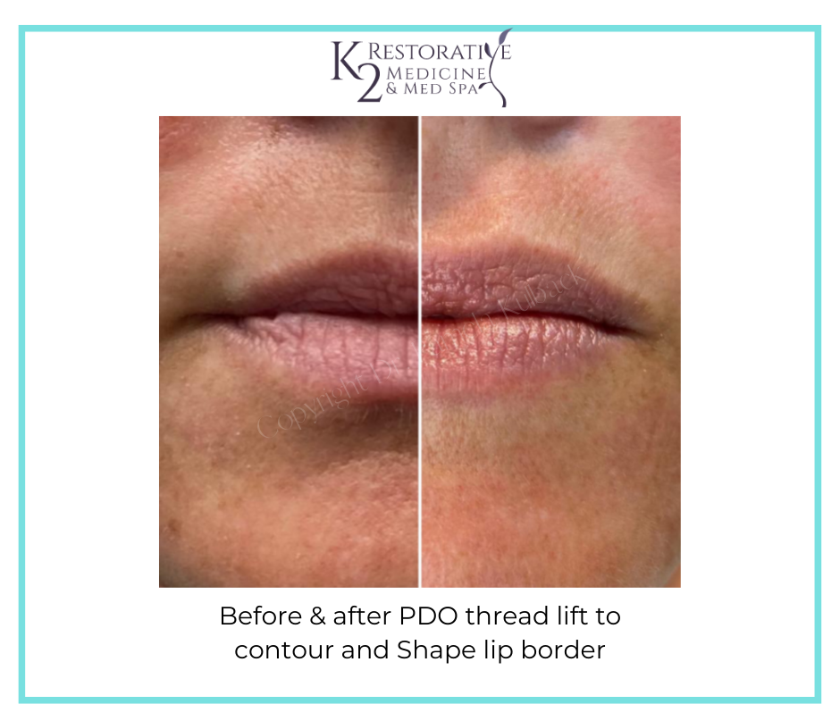 Before & after PDO thread lift to contour and Shape lip border - by Dr. Pamela Kulback - K2 Restorative Medicine (3)