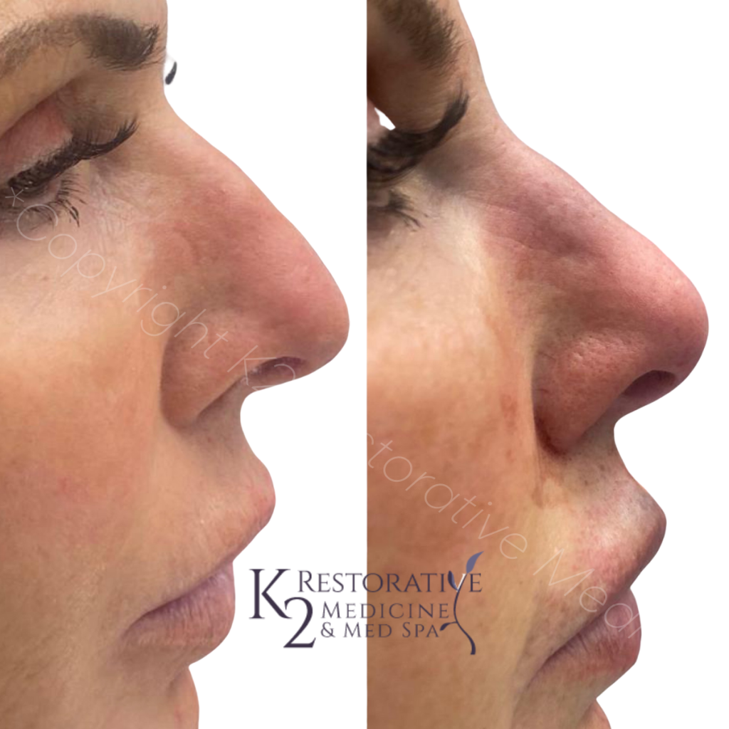 Before and immediately after PDO threads to minimize hump and turn tip of nose up by Dr. Pamela Kulback (1)