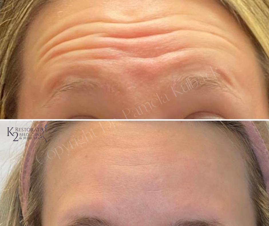 Before and two weeks after Dysport injections for frown and forehead lines - K2 Restorative Medicine