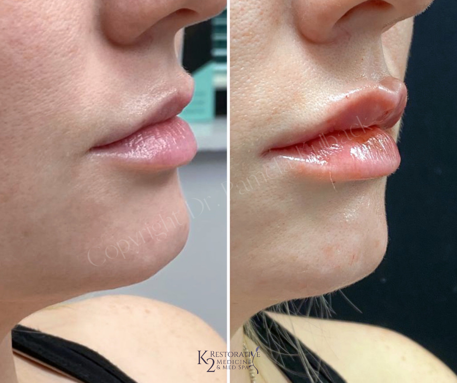 K2 Before and immediately after Restylane KYSSE Before and after - K2 Restorative Medicine