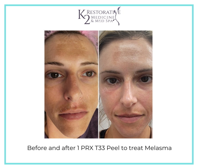 PRX T33 Non-Peeling Biorevitalization Peel | Birmingham, AL