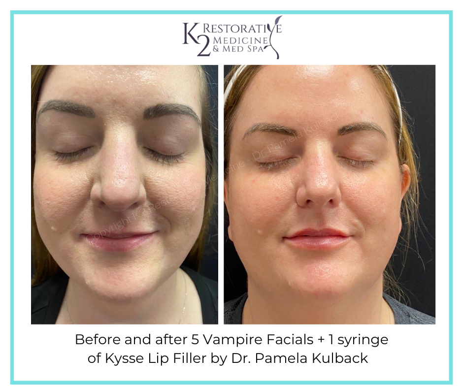Before and after Microneedling with SkinPen + PRP 5 Vampire Facials and Kysse Lip Filler