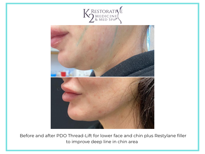 Before and after PDO Thread-Lift for lower face and chin plus Restylane filler to improve deep line in chin area
