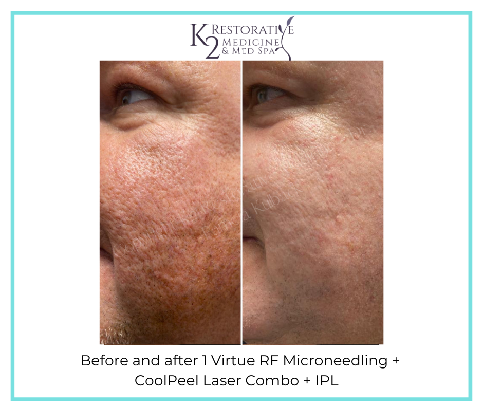 Before and after 1 Virtue RF Microneedling + CoolPeel Laser + IPL Combo by Dr. Pamela Kulback (2)