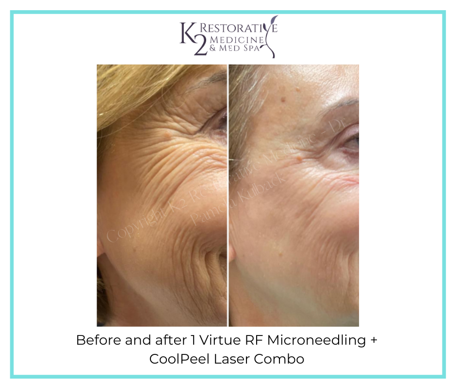 Radiofrequency Microneedling: Before and After Photos